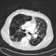 Panlobular emphysema: CT - Computed tomography